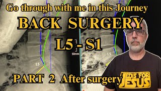 The Surprising Truth About Lumber Fusion Surgery Nobody Tells You PART 2 [upl. by Jordon634]