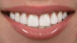 Difference Between Crowns and Veneers [upl. by Eanar]