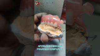 Upper Removable Partial Denture  URPD  Dental Prosthodontics Lab Work  Dental Doctor  dentallab [upl. by Elleinod]