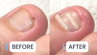 Ingrown Toenail Treatment  PAIN FREE [upl. by Romeo760]