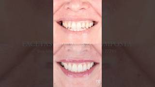 ORTODONTIA E ESTÉTICA DENTAL dentista invisalign facetas [upl. by Herbert]