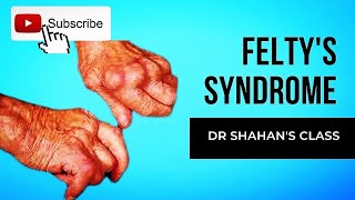 Feltys Syndrome  Dr Shahans Class  Important topic for FMGE and NEETPG [upl. by Meares410]