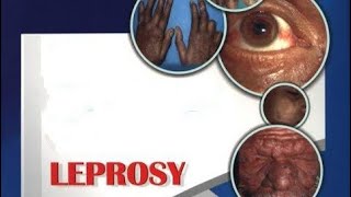 Leprosy and NTM  Diagnosis Treatment  MICROBIOLOGY [upl. by Nylle982]