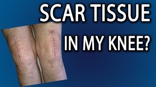 Scar Tissue In Knee How Do I Get Rid Of It [upl. by Phiona]