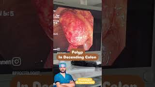 Colonoscopy for early Detection of coloncancer [upl. by Nonohcle]