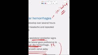 Intracerebral Hemorrhage  Part 3 [upl. by Jezabelle]