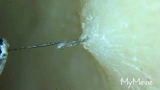 Long Ingrown Hair Plucked All Brand New [upl. by Inail]