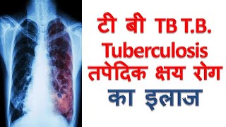 टीबी क्षय रोग का घरेलू उपचार TB T B Ka ilaj Tuberculosis Home Remedies In Hindi [upl. by Axela982]