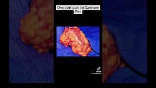 Diverticulitis and Diverticulosis on the Carnivore Diet [upl. by Hux1]