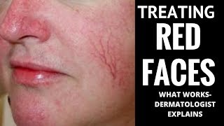 How to treat red faces [upl. by Neumann]