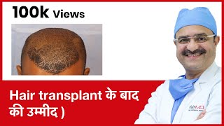 Hair Growth What To Expect After Hair Transplant Hair transplant के बाद की उम्मीद   In HINDI [upl. by Ayhtak]