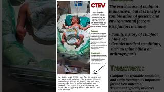 CTEV disease ❌🔥  Congenital Talipes Equinovarus🤕😖  hospital newbornbaby treatment motivation [upl. by Leith]