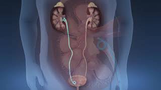 Extracorporeal shock wave lithotripsy ESWL machine  Usapang Pangkalusugan [upl. by Danczyk]