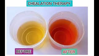 orange colour urine in chelation therapydeforoxamineiron intoxicationthalassemia [upl. by Elletnuahc]