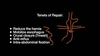 Hiatal  Paraesophageal Hernias and their Repair [upl. by Waverly]