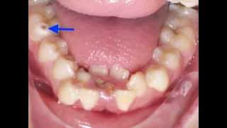 Lower Incisor Extraction Time Lapse Video Kyger Orthodontics [upl. by Persas]