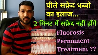 दाँतो के पीले सफ़ेद धब्बो का इलाज । Dental Fluorosis permanent treatment [upl. by Srini173]