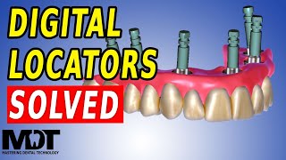 Fixed Locator Denture and NEW Digital Locator Library for ZEST Locators in Exocad 32 [upl. by Dode]