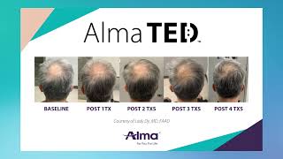 Alma TED  Hair loss solution  Another Look Hair Institute [upl. by Stranger]