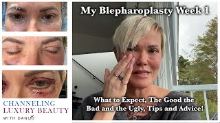 Blepharoplasty Week 1  Recovery amp What to Expect Eyelid Surgery amp CO2 Channeling Luxury Beauty [upl. by Colier92]