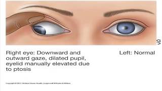 How to remember Cranial Nerves part 4 Abducens CNVI and Oculomotor nerve CNIII [upl. by Oehsen]