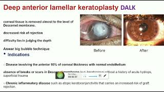 keratoplasty part 2 [upl. by Eentihw]