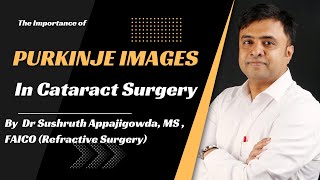 The Importance of Purkinje Images in Cataract Surgery [upl. by Bach]