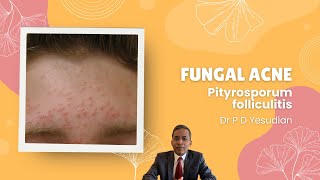 Pityrosporum or Malassezia folliculitis fungal acne [upl. by Lindsay391]