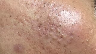 Remove perennial blackheads around lips and under chin 2024  010  Acne Treatment [upl. by Ohare294]