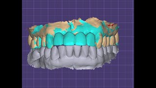 Preop scan merging in exocad [upl. by Danita345]