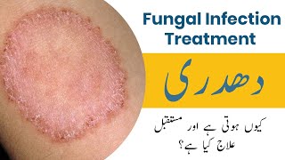 Fungal Infection Treatment in UrduHindi  Dadri ka ilaj in UrduHindi  Ringworm Treatment [upl. by Lomax]