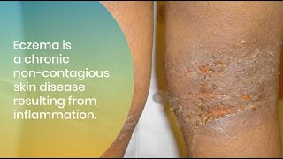 Treating and Managing Eczema in All Skin of Colors [upl. by Novar699]