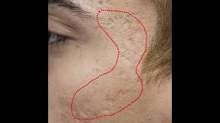 Acne Scar Treatment [upl. by Hnahc]