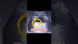 Ureteric Stone  VUJ Stone  Bladder Stone on Ultrasound [upl. by Knowling]