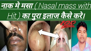 Nasal Polyps नाक मे मसा  Nasal mass with Hit  का पुरा इलाज कैसे करे। Abhia2zmedical [upl. by Laband]