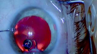 ICL Explantation  Senile Cataract  Nanolaser  Drmed AmirMobarez Parasta  MUNICH EYE [upl. by Rector]