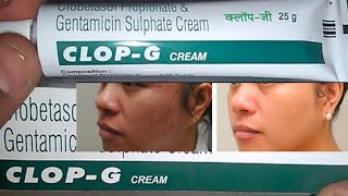 CLOP  G Cream  Skin Whitening Creams  CLOP  G Cream review and benefit kannada videos [upl. by Herzel]