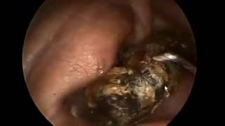 Hard Enucleation Cases for the Elderly 19 Minutes [upl. by Colis397]