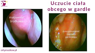 Uczucie ciała obcego w gardle kluska w gardle  co to może być [upl. by Nwahsor]