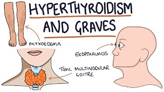 Understanding Hyperthyroidism and Graves Disease [upl. by Llednohs]