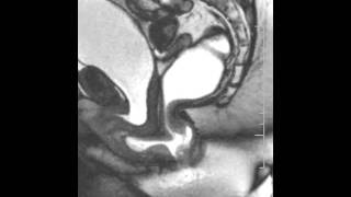 Dynamic Pelvic MRI showing rectocele Pelvic Floor Center of Orlando [upl. by Werd460]