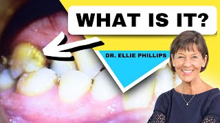 What is Dental Plaque How to Prevent More From Forming [upl. by Zoldi79]