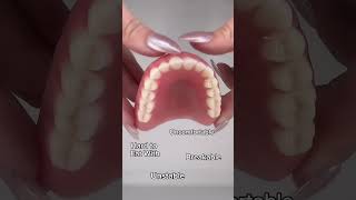 Dentures versus dental implants — which should you go with dentalimplants denture dentalissues [upl. by Tdnarb]