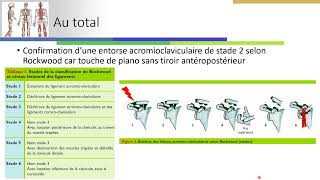 entorse acromio claviculaire aspects échographiques [upl. by Eiramnaej]