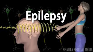 Epilepsy Types of seizures Symptoms Pathophysiology Causes and Treatments Animation [upl. by Norling]