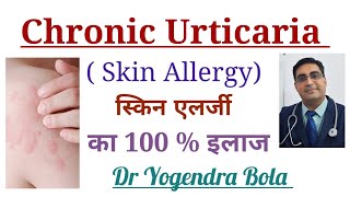 Chronic Urticaria Skin Allergy के कारण and Complete Treatment in Hindi [upl. by Aitropal]