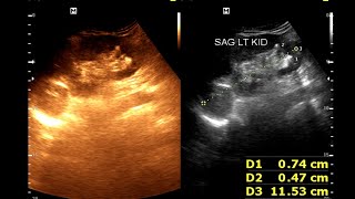 Hydro nephrosis  Renal cortical cyst  Renal calculus [upl. by Eidolem]