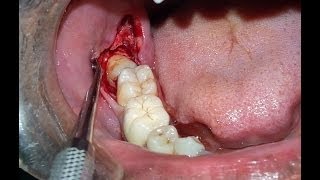 Surgical Extraction of Horizontally Impacted Mandibular Right 3rd Molar Case By Dr Akash Akinwar [upl. by Foley]