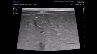 Necrotizing enterocolitis NEC Ultrasound [upl. by Atnas585]