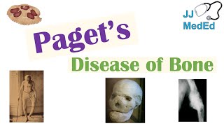 Paget’s Disease of Bone Osteitis Deformans  Causes Pathogenesis Symptoms Diagnosis amp Treatment [upl. by Keyser]